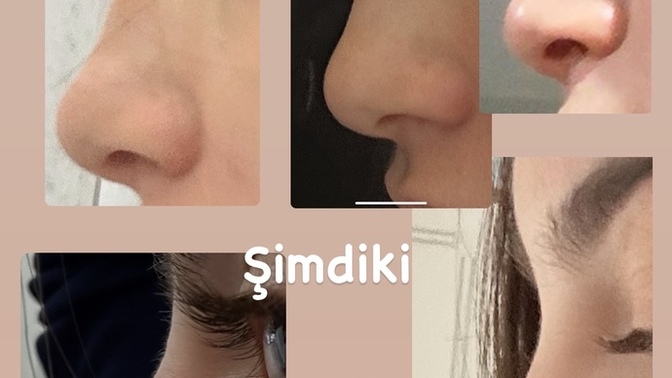 Burnumda eskiye göre bariz kemer mi çıkmış?
