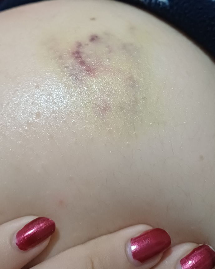 Bacağımda arada böyle morluklar oluo bi yere de çarpmadım sebebi ne olabilir ya?