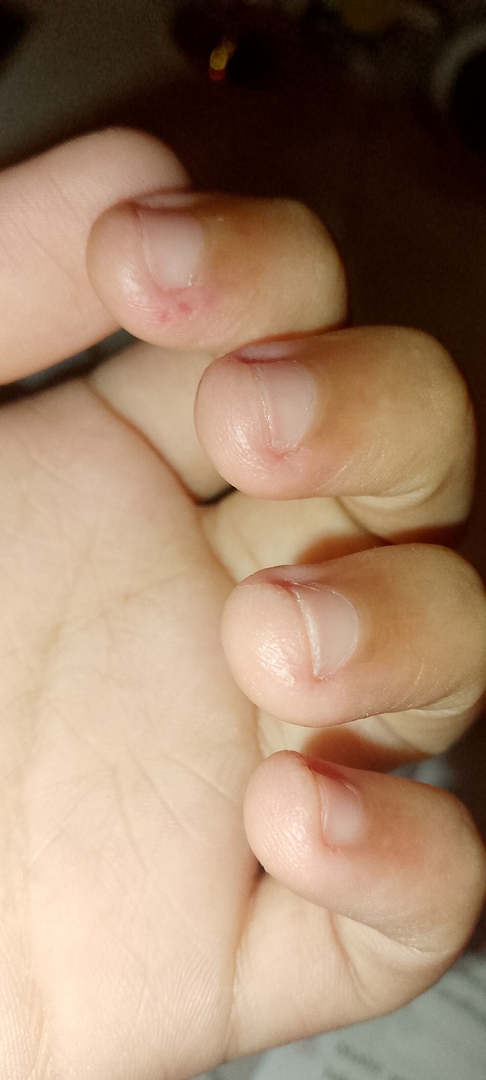 Tırnaklarımın ısırılmasından kaynaklanan durumu🥺