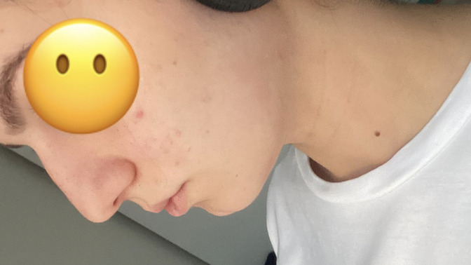 Arkadaşlar sizce burnuma estik mi yaptırmalıyım yoksa dolgu mu?