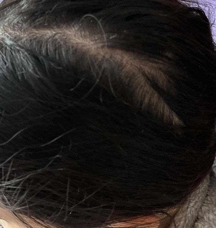 Saçım mı kelleşmiş yoksa ayrım mı?