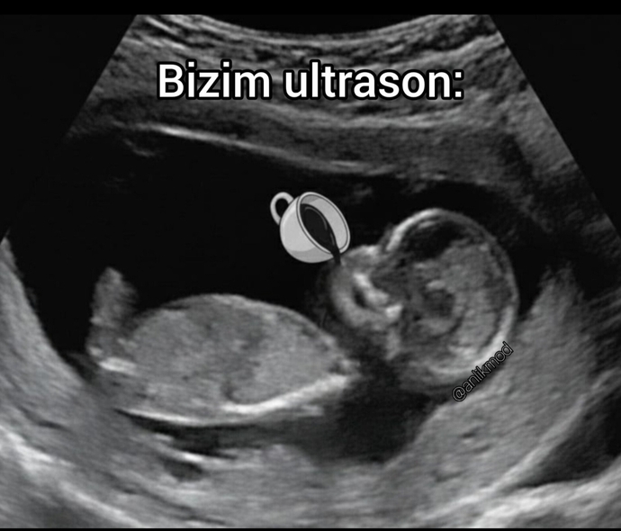 Doğacak yeğenimin ultrasonuna baktırtık böyle bir şey çıkmış sizce bu ne demek? bilgisi olan var mı 🤭🤭?