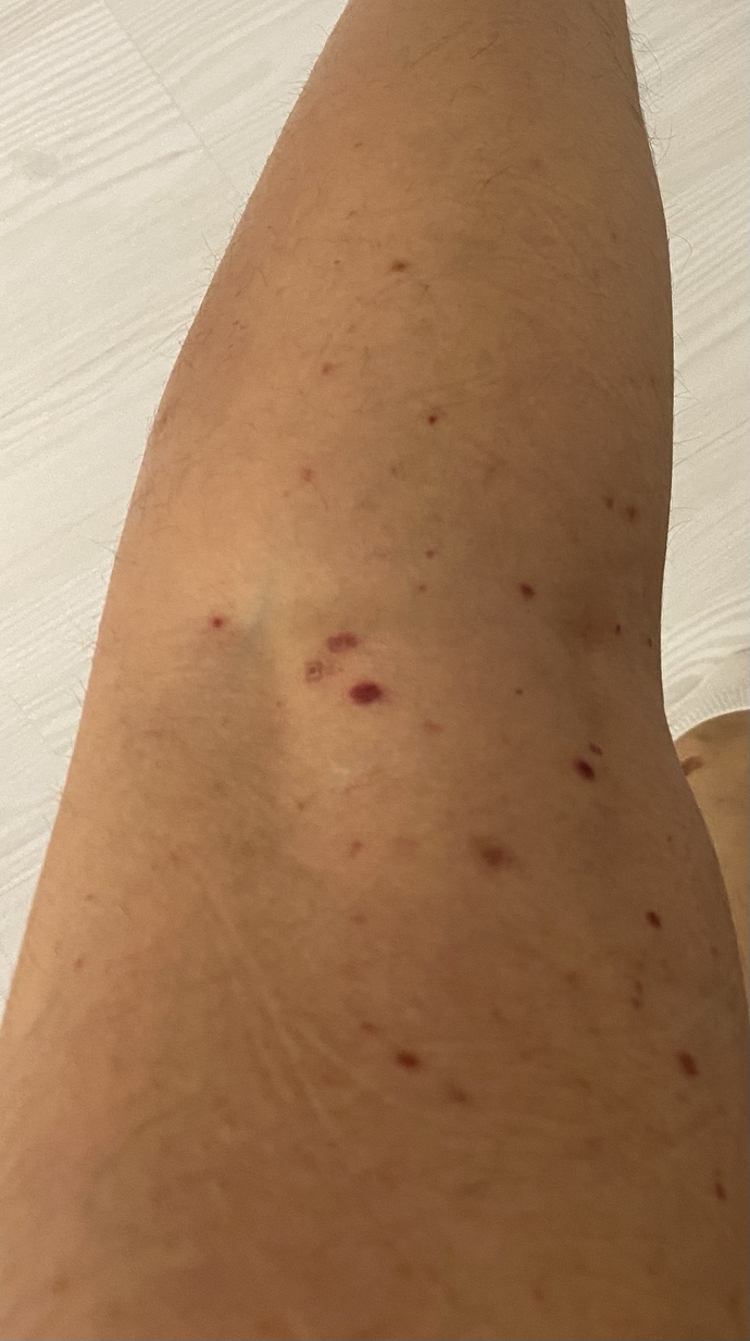 Bacağında böyle şeyler çıkan oldu mu kaşıntısız basenlerimde kollarım ve karnımda da var?