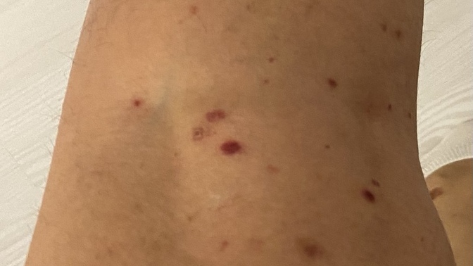 Bacağında böyle şeyler çıkan oldu mu kaşıntısız basenlerimde kollarım ve karnımda da var?