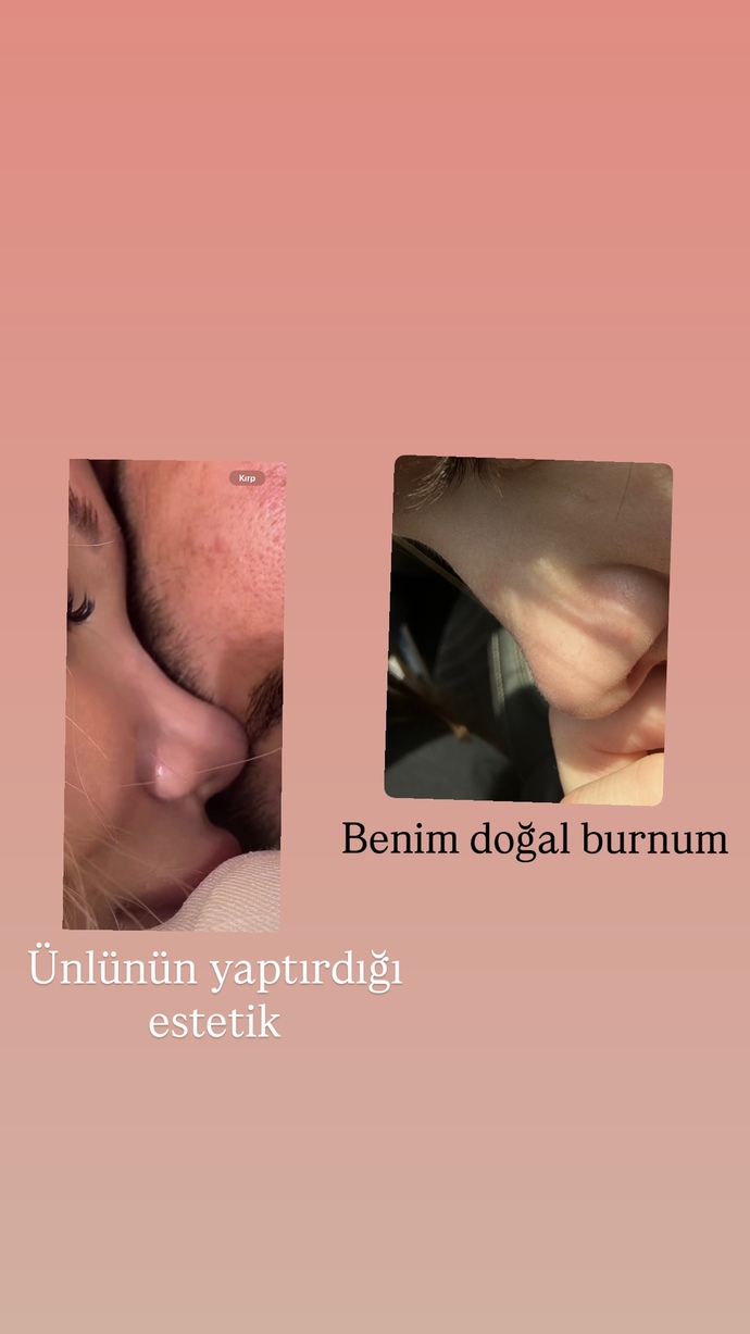 İnsanlar burnunu benim gibi yapmak için mi estetik oluyor ahahah?
