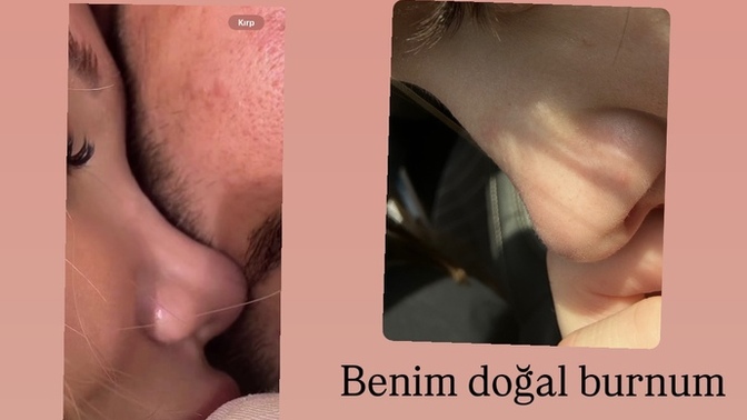 İnsanlar burnunu benim gibi yapmak için mi estetik oluyor ahahah?