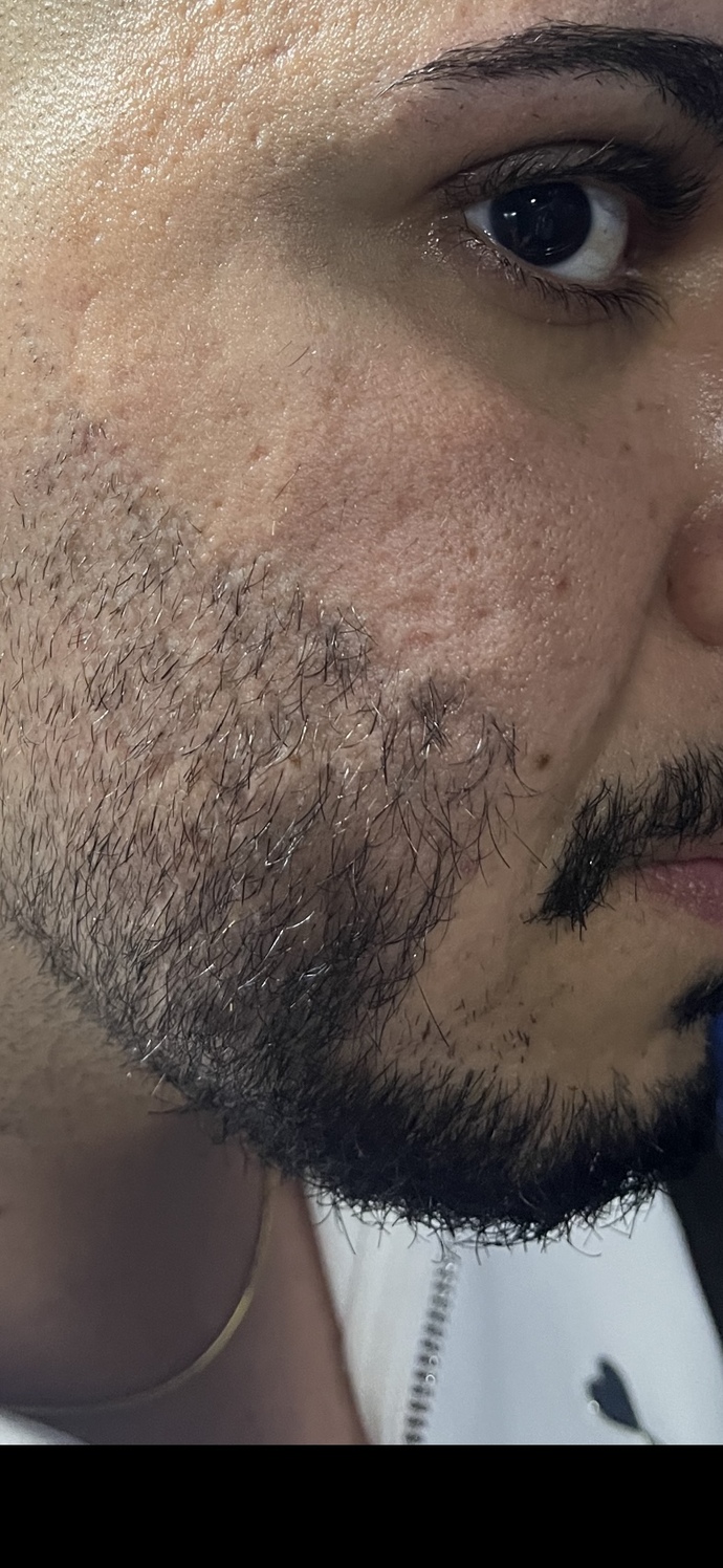 Cildim yüzünden bunalımdayım özgüvenim sıfır çokmu kötü (bu en kötü durduğu hali şiddetli beyaz ışık altında normalde böyle değil?