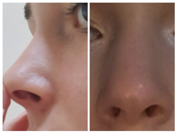 Uzun zamadır burun estetiği ya da  dolgu istiyorum sizce yaptırmalı mıyım?