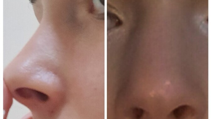 Uzun zamadır burun estetiği ya da  dolgu istiyorum sizce yaptırmalı mıyım?