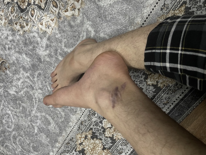 Bu yara izine dövme olur mu?