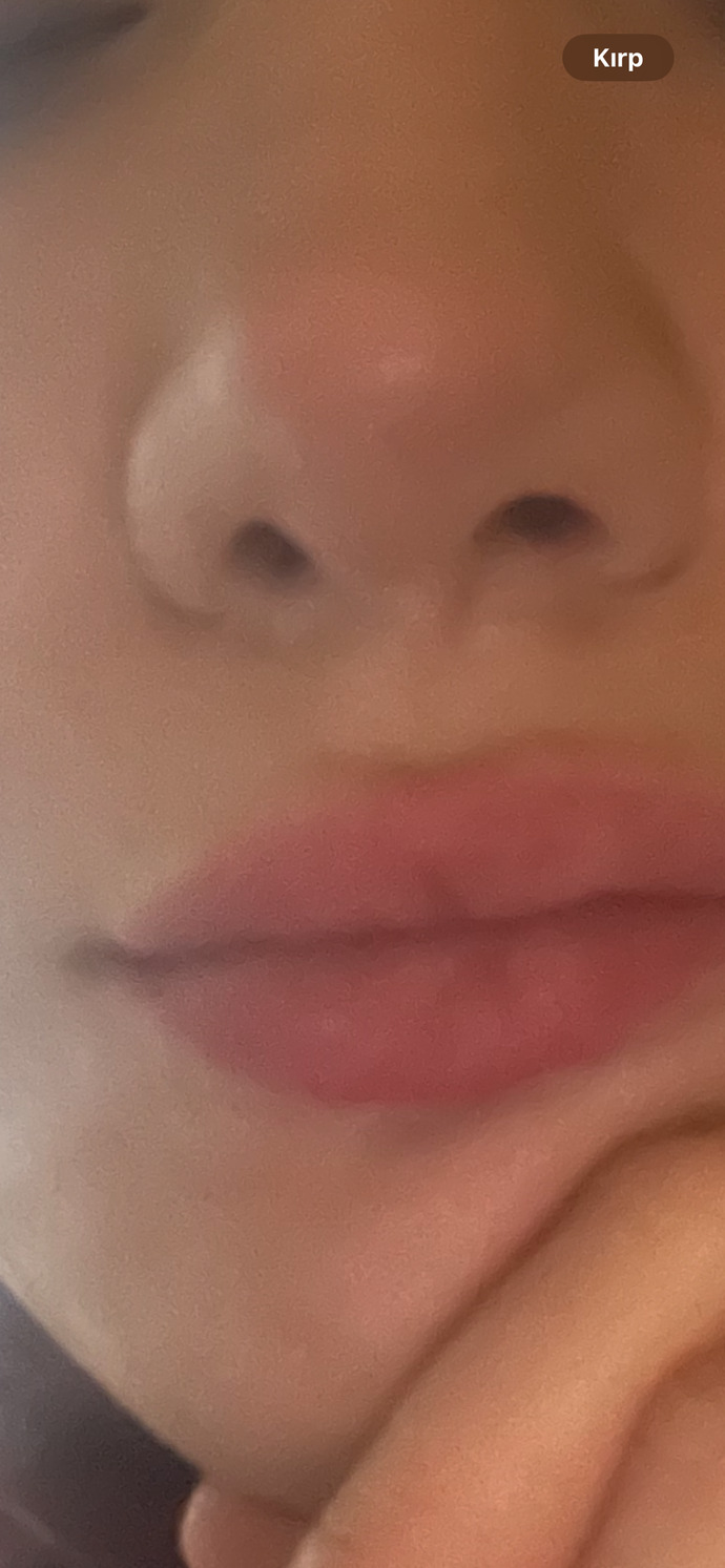 Dudağım dolgu mu sizce?