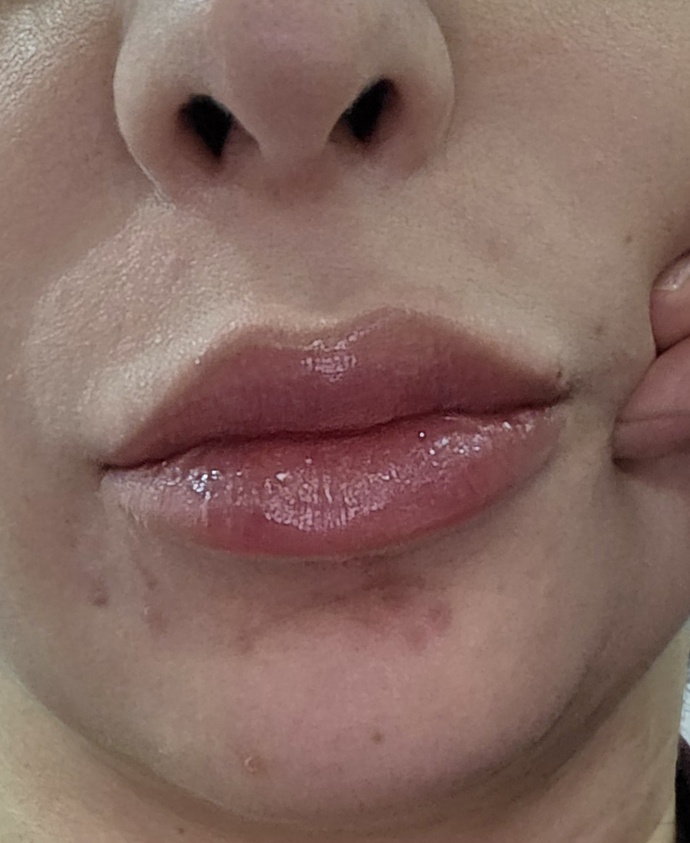 Dudak dolgum nasıl olmuş?