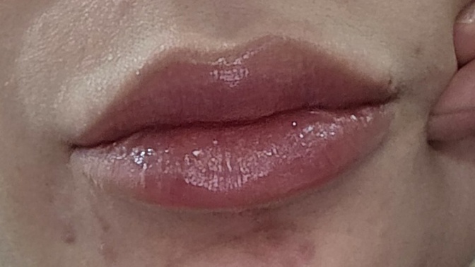 Dudak dolgum nasıl olmuş?