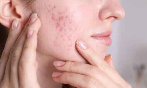 Sivilce için zoretanin, roaccutane gibi ilaç kullanan var mı?