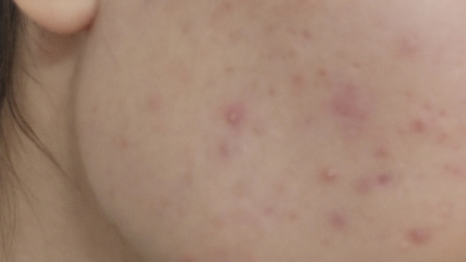 Abi ağlayacağım artık yeter ya 😭 Neden bu kadar sivilce çıkıyor?