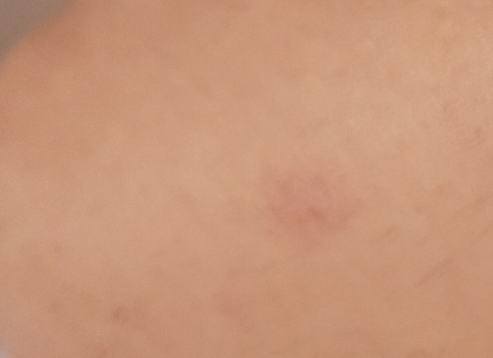 Vücutta kaşıntılı kuru kızarıklık nedir?