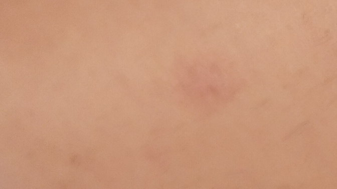 Vücutta kaşıntılı kuru kızarıklık nedir?