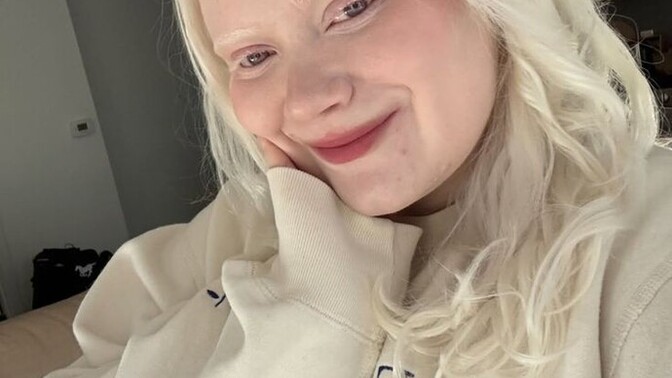 Albino'lar çirkin midir sizce?