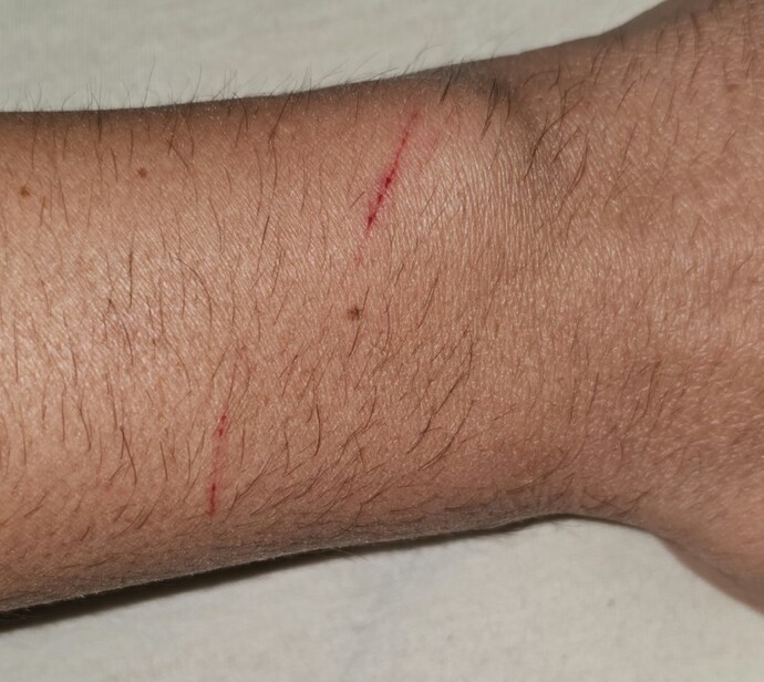 Kedi tırmaladı? Kuduz aşısına gerek var mıdır?