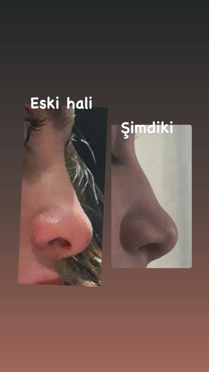Burnum eski haline kemerleşmiş mi?