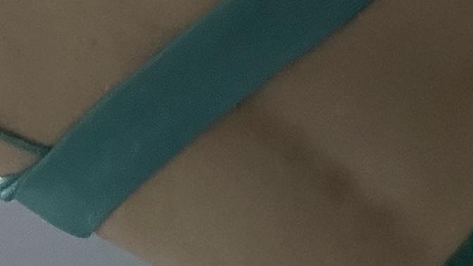 Sırtımda çok mu leke var?
