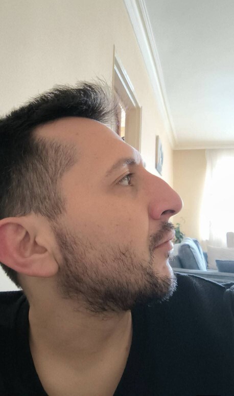 Burun estetiği 7. Ay sonrası?