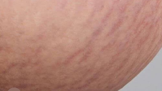 Kırmızı cilt çatlağı çok kötü görünüyor mu?