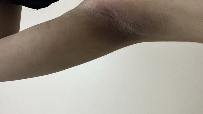 Expigment %4 sonrası oluşan leke gecer mi?