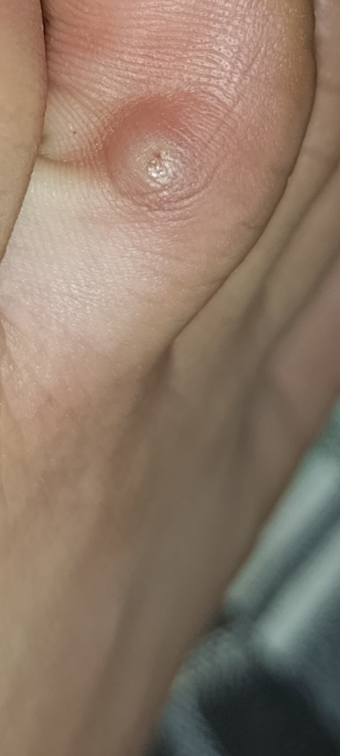 Bu nedir ayağımda çıkmış parmakta?