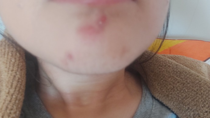 Çenemde sivilce çıktı ne yapmalıyım?