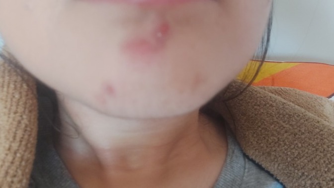 Çenemde sivilce çıktı ne yapmalıyım?