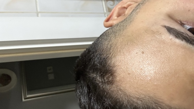 Saçlar gitmiş durumda ön kısmı üst arka vs bi sıkıntı yok bi tek üst bu kısma ekme işlemi yapılıyor mu?