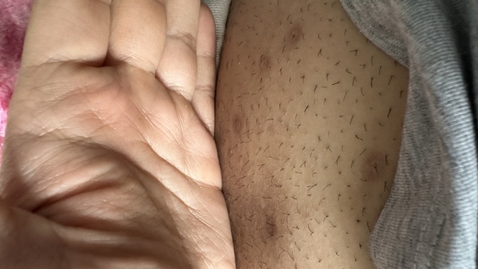 Bu iz jiletle aldıktan sonra oldu yara oldu kaşıdım vs sonra işte izler kalmış gider mi bunlar?