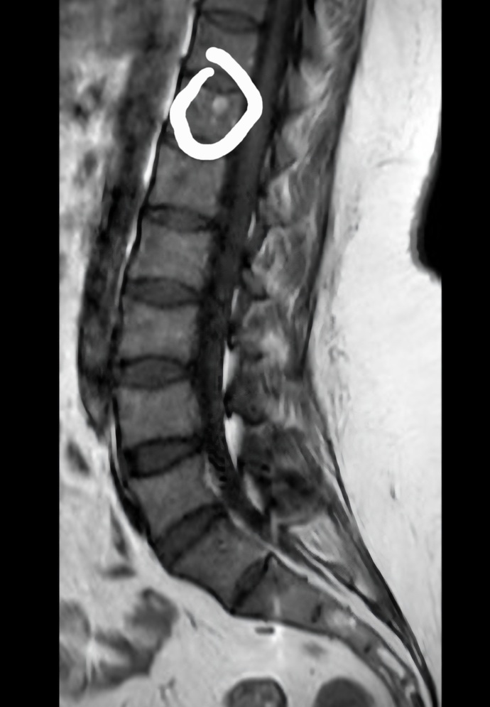 Sağlıktan anlayanlar yuvarlak içine aldığım şey nedir rapor çıkmadı görüntüye baktı doktor fıtık başlangıcı dedi?