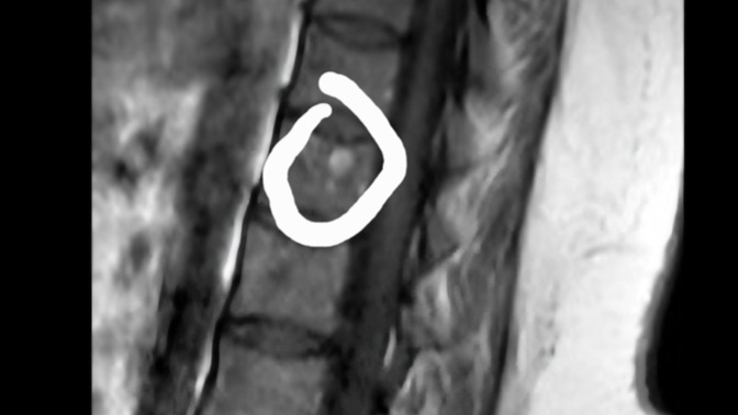 Sağlıktan anlayanlar yuvarlak içine aldığım şey nedir rapor çıkmadı görüntüye baktı doktor fıtık başlangıcı dedi?