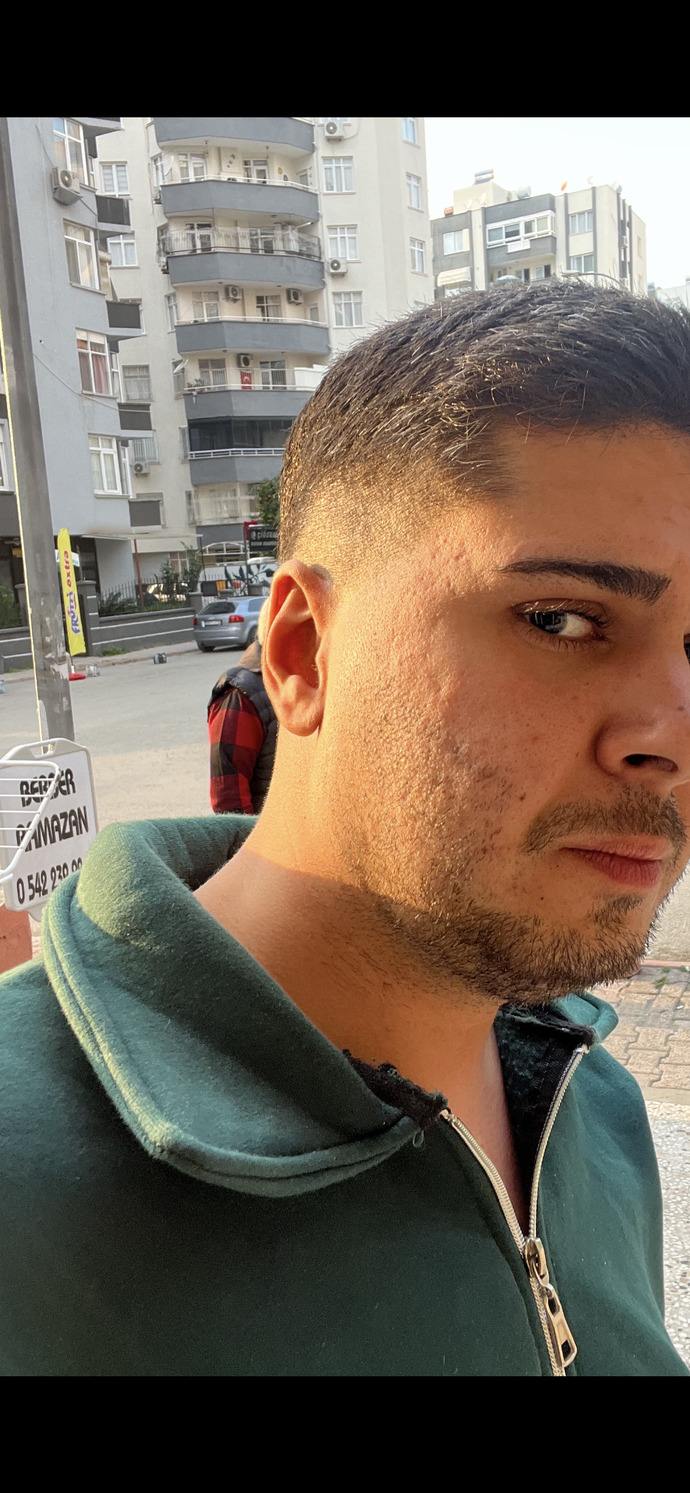 Cildim çokmu kötü cildi böyle olan biri ile sevgili olur muydunuz?
