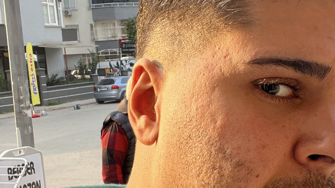 Cildim çokmu kötü cildi böyle olan biri ile sevgili olur muydunuz?
