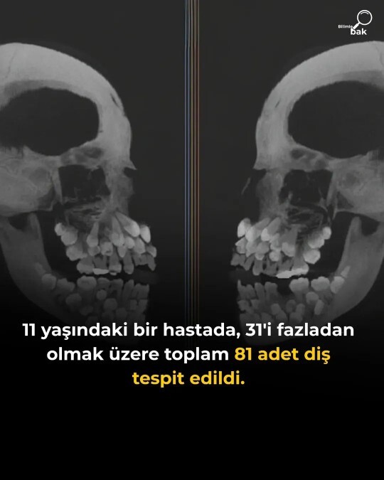 En fazla kaç dişiniz olabilir?