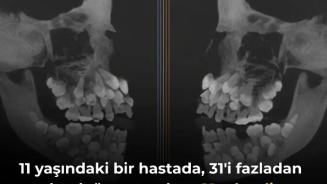En fazla kaç dişiniz olabilir?