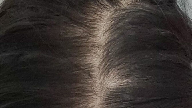 Şu an  nişanlıyım ve saçlarım bu durumda. Sizce saçlarım cansız ve az diye nisanlima. soylemek zorunda mıyım?
