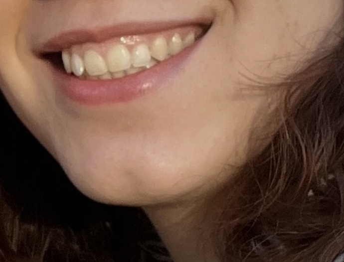 Gülerken diş etlerim çok gözüküyor🥲 Diş eti estetiği olmalı mıyım sizce?
