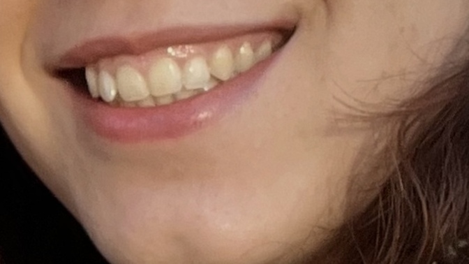 Gülerken diş etlerim çok gözüküyor🥲 Diş eti estetiği olmalı mıyım sizce?