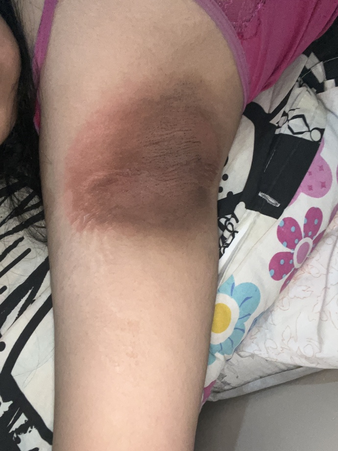 Kullandigim kremden koltuk altim boyle oldu cok cok cok az bi kararma vardi expigment %4 u fazla kullaninca bu hale geldi gecer mi?
