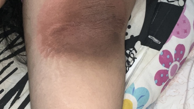 Kullandigim kremden koltuk altim boyle oldu cok cok cok az bi kararma vardi expigment %4 u fazla kullaninca bu hale geldi gecer mi?