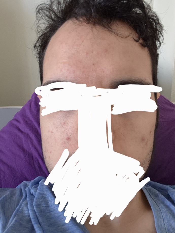 Yüzümde aniden çoşan sivilce ve akneler için yurtdışına çıkmadan önce ne yapmalıyım?
