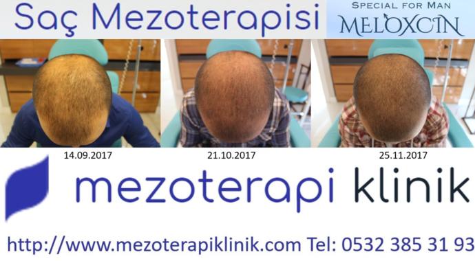 Saç mezoterapisi acıtır mı?