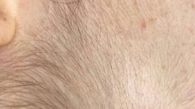 Yüzümde aşırı sakal çıkıyor, kalıcı çözüm ve tedavi yöntemleri neler?