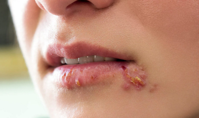 İlk defa genital uçuk (herpes) çıktı, acısı geçmiyor, ne yapmalıyım 😔?