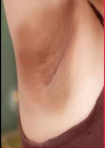 Kol altim kara nasil beyazlatirim?