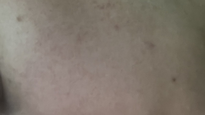 Kozmetik alerjisi sonrası cilt bariyeri mahvoldu, aşırı kuruluk ve soyulma için ne yapmalıyım 😞?